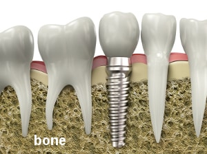 Rigenerazione ossea dentale e ricostruzione ossea dentale